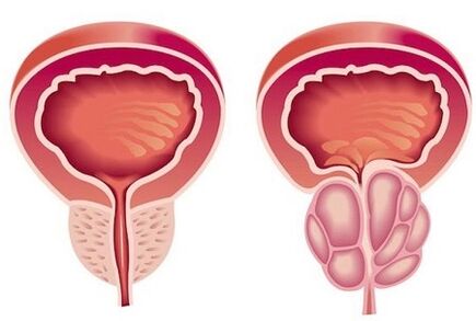 Prostatitis symptoms in men